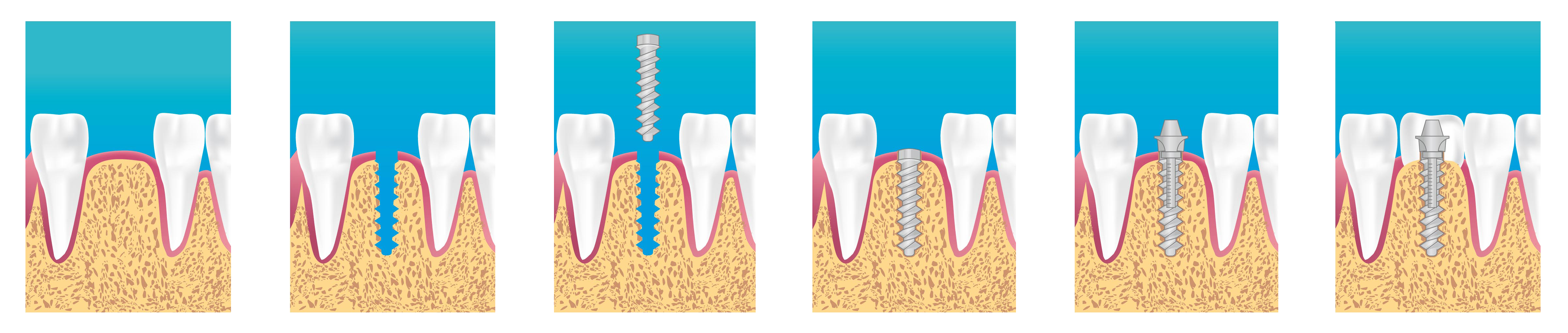Зубы импланты поэтапно. Одноэтапная дентальная имплантация. Двухэтапная имплантация. Эндооссальная (внутрикостная) имплантация. Классическая двухэтапная имплантация зубов.